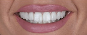 2 - after