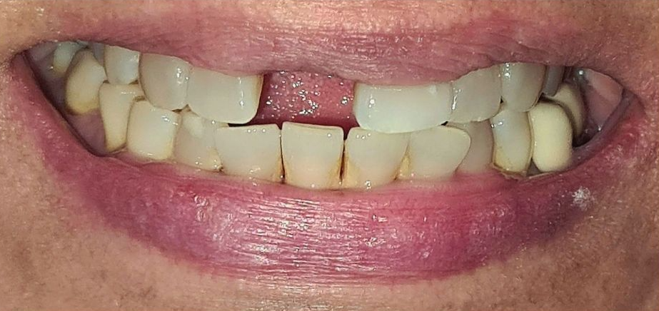 4 - before